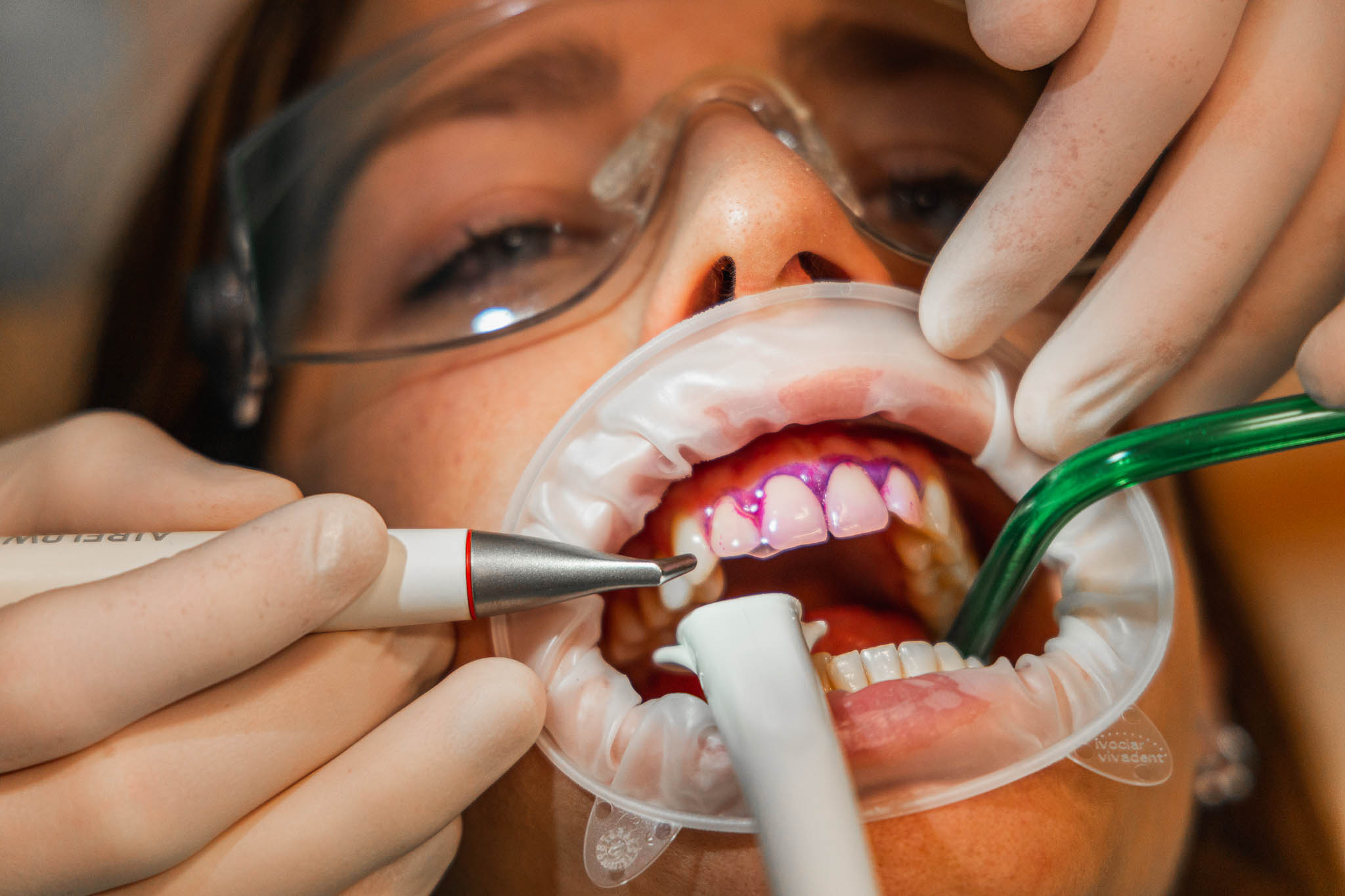 Una seduta di igiene orale Professionale presso lo Studio Dentistico Perucci